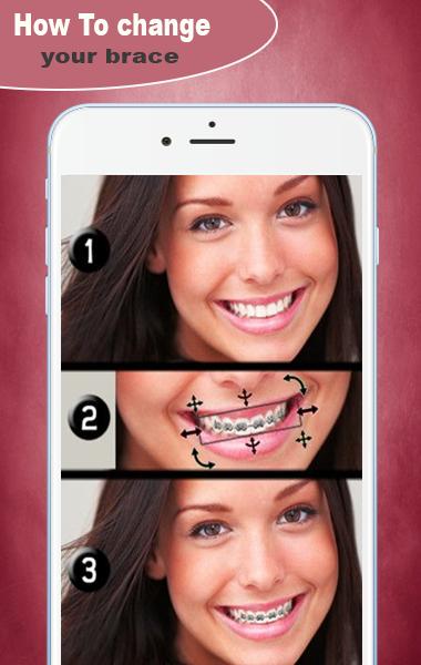Braces Booth Pro