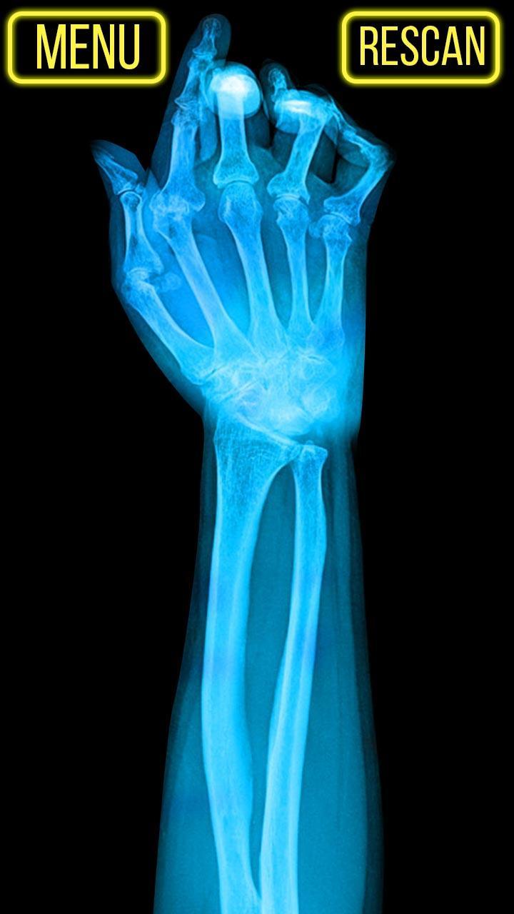 Xray Fracture Hand Prank