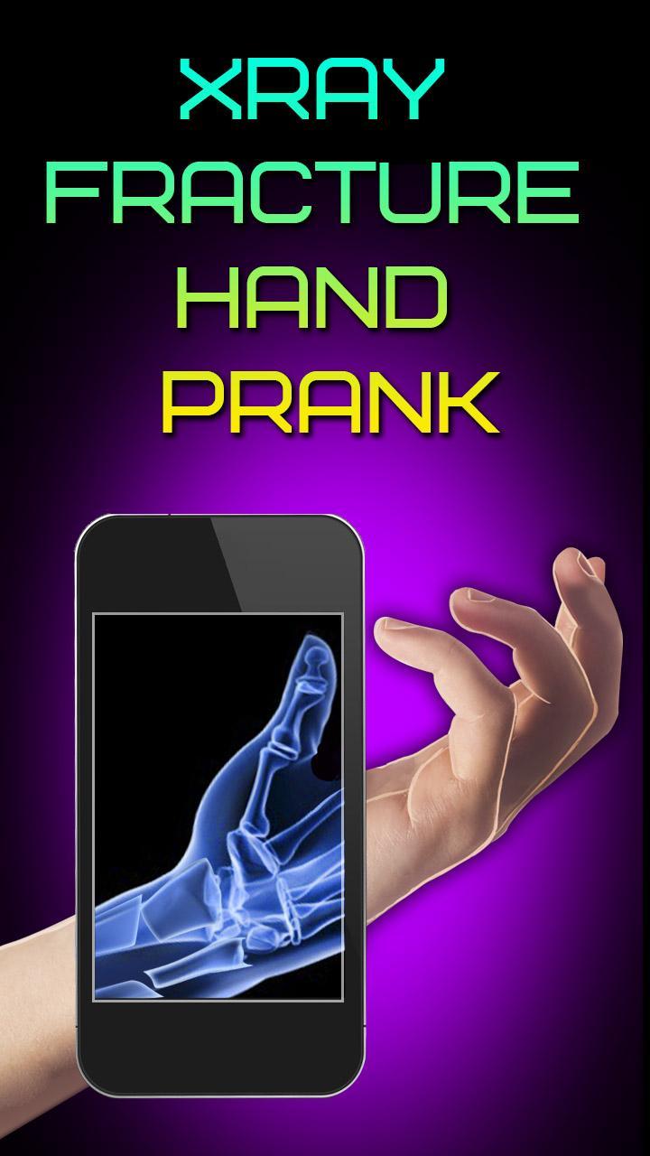 Xray Fracture Hand Prank