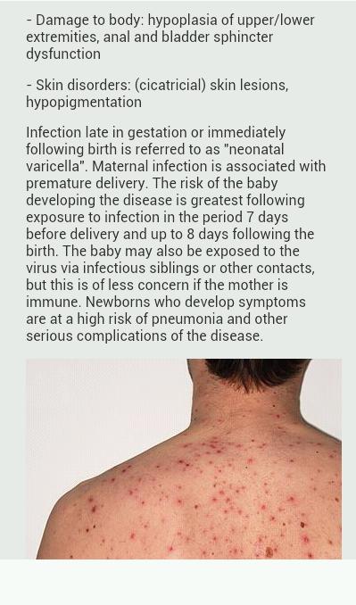 Chickenpox Disease